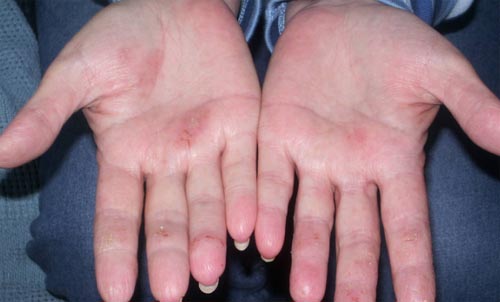 Diabetes and Hyperbaric Oxygen